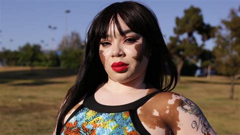 vitiligo porn